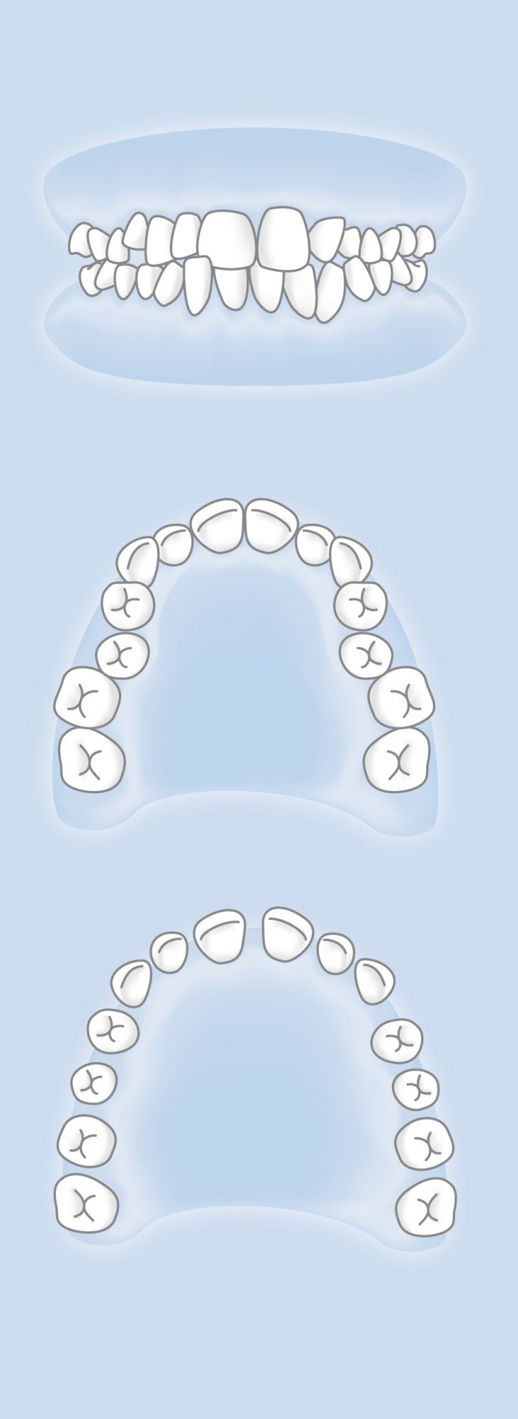 Affollamento dentale vs. diastema e spaziatura