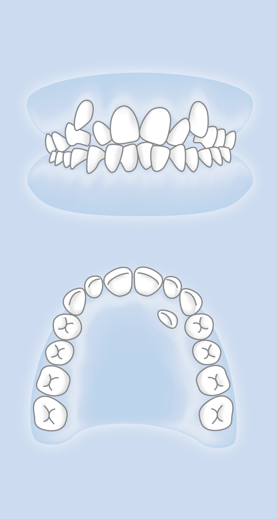 Verlagerte Zähne